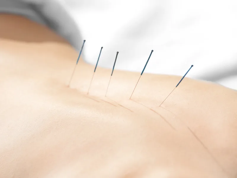 Acupuncture at Schomaker Chiropractic Clinic in Elk River