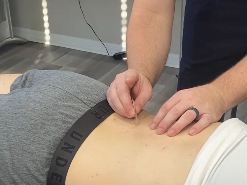 How Dry Needling works at Schomaker Chiropractic Clinic