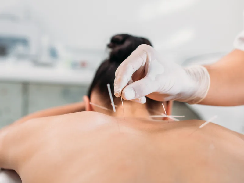 Dry Needling at Schomaker Chiropractic Clinic in Elk River