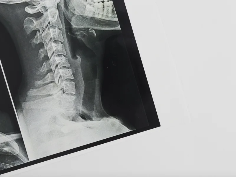 X-Rays at Schomaker Chiropractic Clinic in Elk River